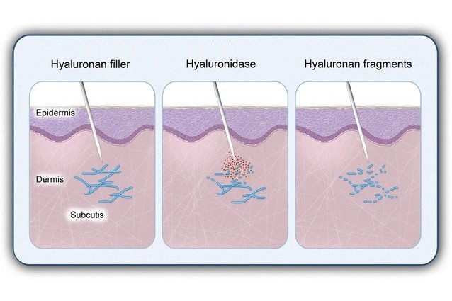 ヒアルロニダーゼはフィラー溶解剤として機能します。